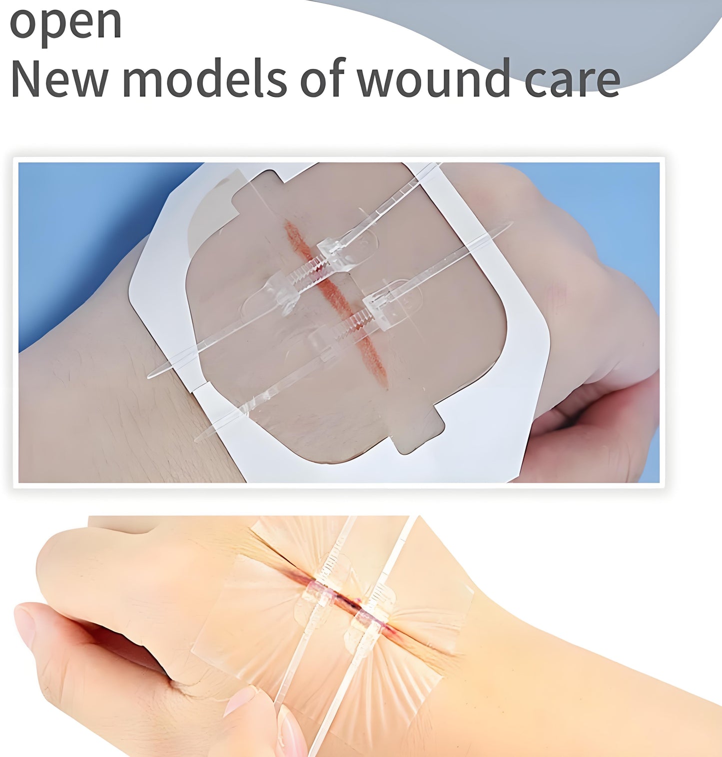 Antaly Wound Closure Device