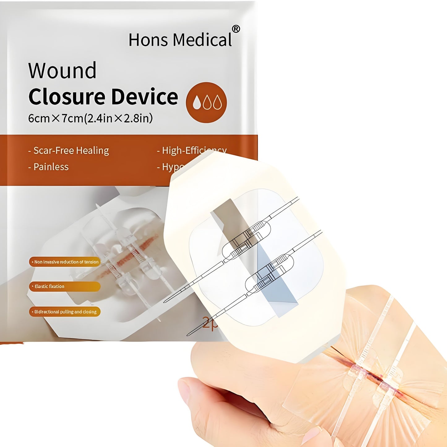 Antaly Wound Closure Device